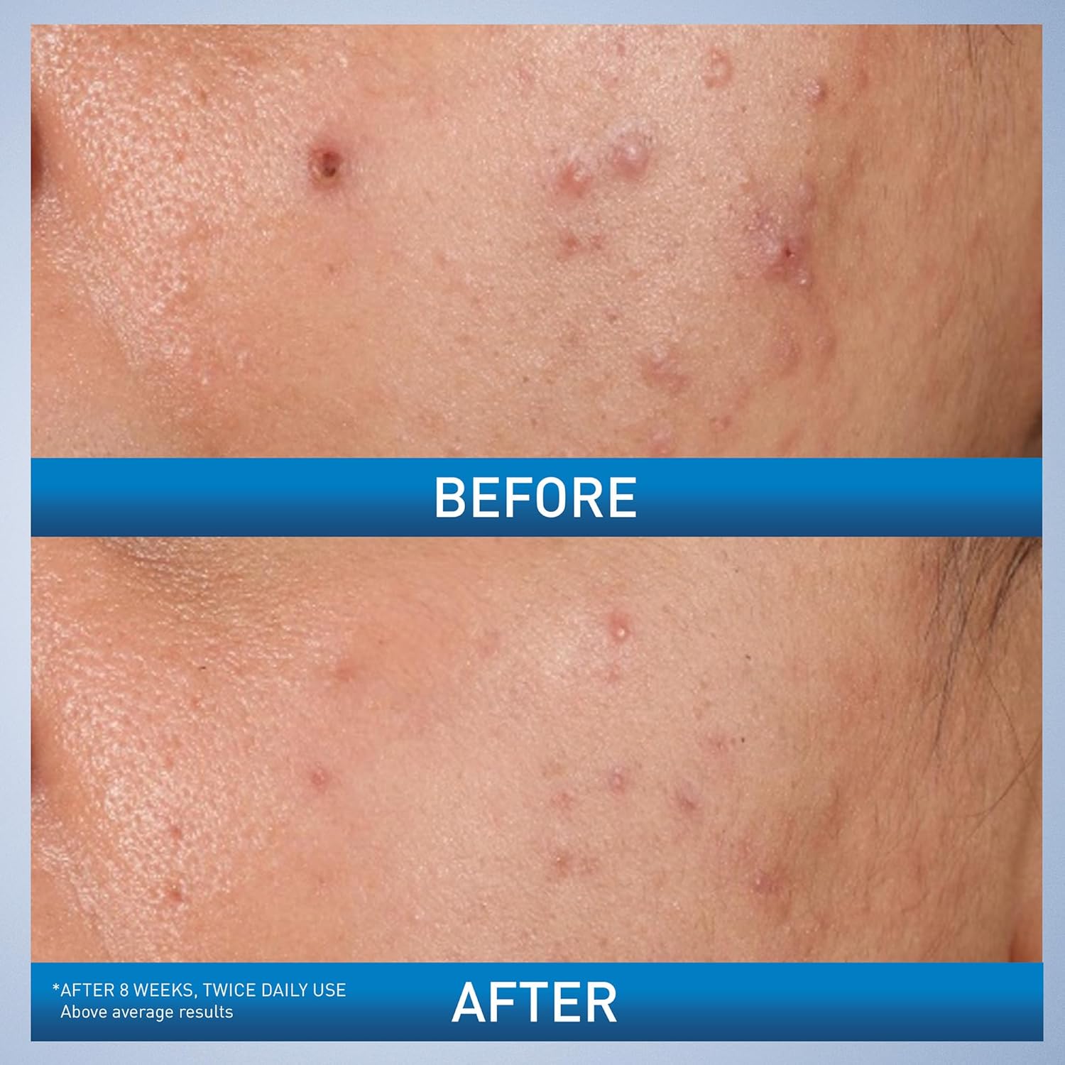 CeraVe Acne control gel 2% Salicylic Acid